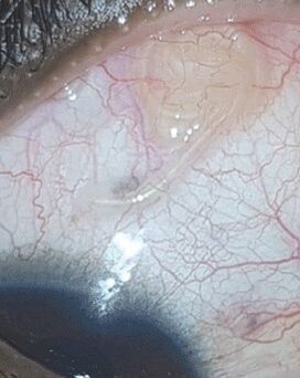 NEOflorax pomohol zbaviť sa červa v oku